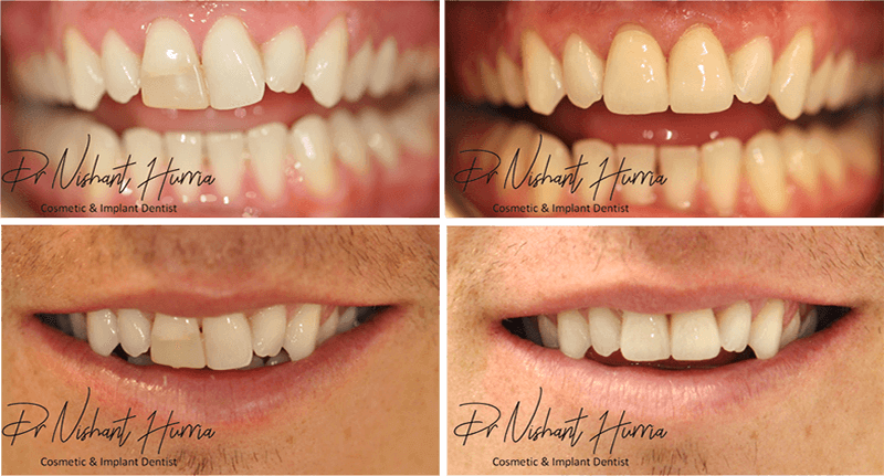 Before and after result: Anterior crowns