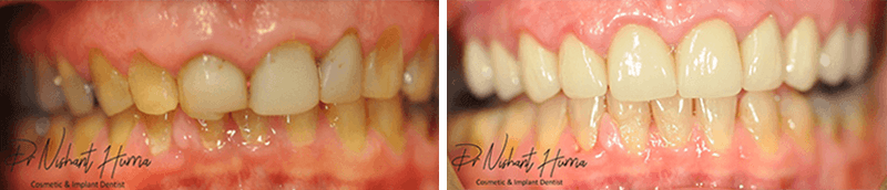 Before and after result: Upper full-arch crowns and veneers