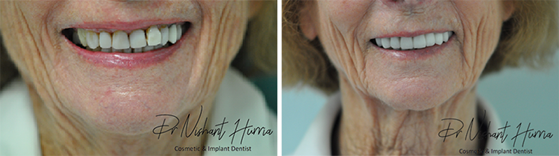 Before and after result: Anterior crowns, veneers and bridge