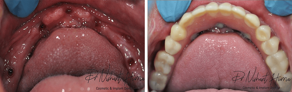 Before and after result: All-on-5 fixed implant prosthesis